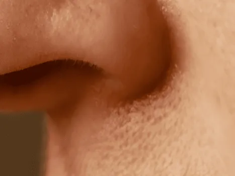 Luomen poisto after example 1