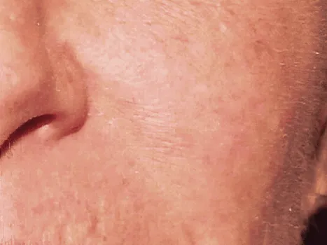 Luomen poisto after example 2