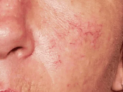 Luomen poisto before example 2