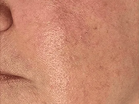 Luomen poisto after example 3