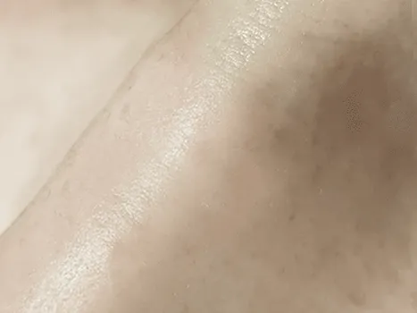 Luomen poisto after example 4