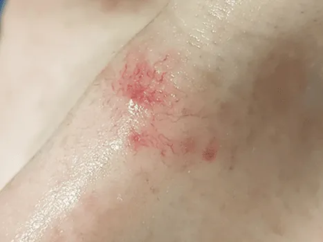 Luomen poisto before example 4