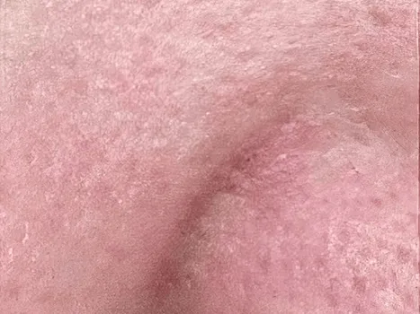 Luomen poisto after example 2