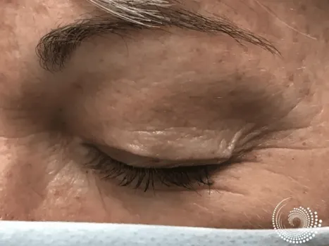 Luomen poisto after example 4