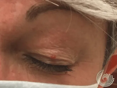 Luomen poisto before example 4