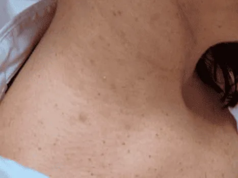 Luomen poisto after example 2