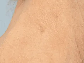 Luomen poisto after example 3