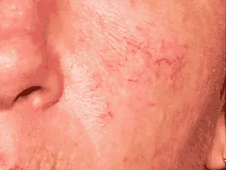 Luomen poisto before example 4