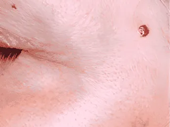 Luomen poisto before example 6