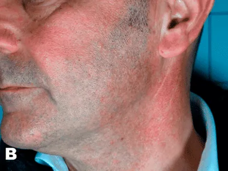 Luomen poisto after example 7