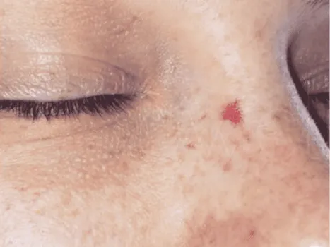 Luomen poisto before example 1