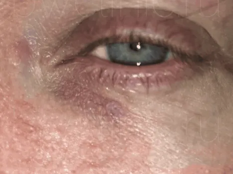 Luomen poisto after example 2