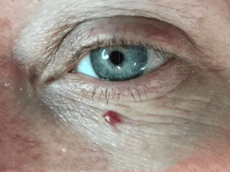 Luomen poisto before example 2