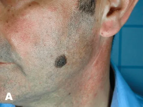 Luomen poisto before example 3