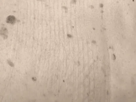 Luomen poisto before example 4