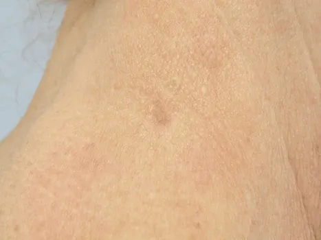 Luomen poisto after example 1