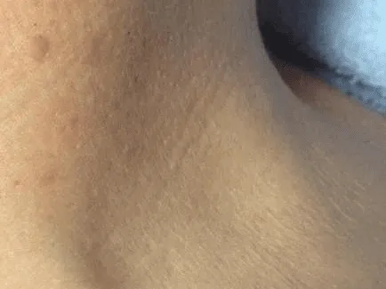 Luomen poisto after example 2