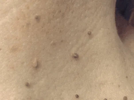 Luomen poisto before example 2