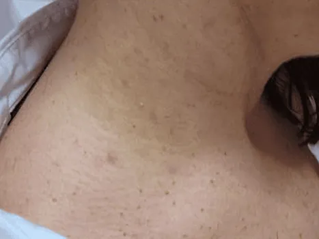 Luomen poisto after example 3