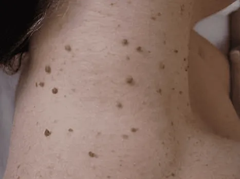 Luomen poisto before example 3