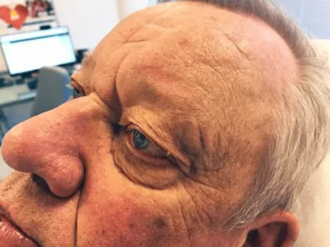 Luomen poisto after example 4